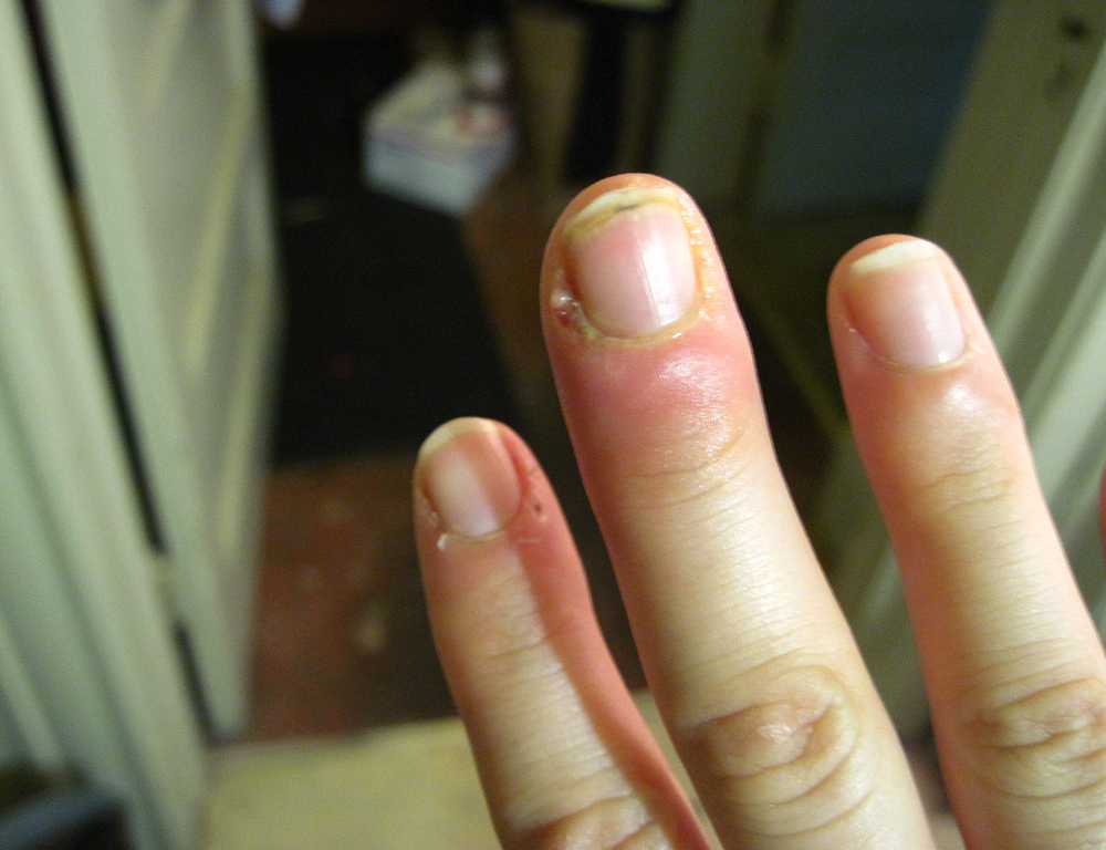 Cuticle Infection